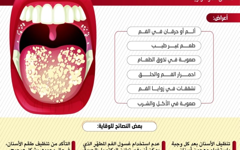 أعراض تجنب فطريات الفم