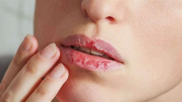 قبل بداية الخريف.. وصفات طبيعية لترطيب الشفاه والوقاية من الجفاف