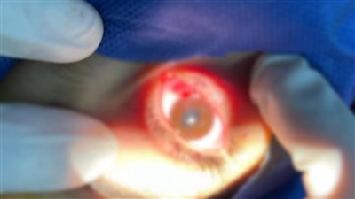 ارتعاش جفن العين.. إشارة لا يجب تجاهلها