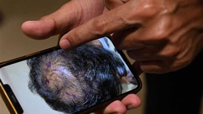 مصل جديد يعيد الأمل لملايين المصابين ب تساقط الشعر خلال 20 يوما