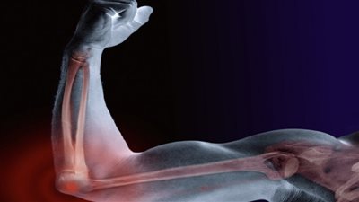 6 أطعمة تقوّي العظام وتحميها من الهشاشة مع التقدم في العمر