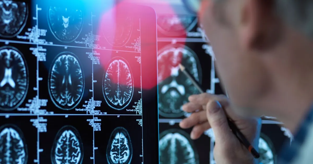 دراسة: مسار “سكري” في الدماغ يكشف سر الاكتئاب المقاوم للعلاج