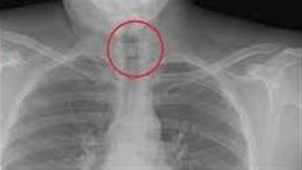 إنقاذ طالبة في الأقصر بعد ابتلاع دبوس أثناء ضبط الحجاب