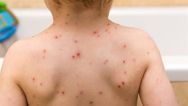 حقيقة تسجيل إصابات جديدة بمرض الجدري المائي بين طلاب المنوفية