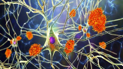 من الفياجرا إلى لقاح الهربس.. أدوية غريبة تقاتل ألزهايمر!