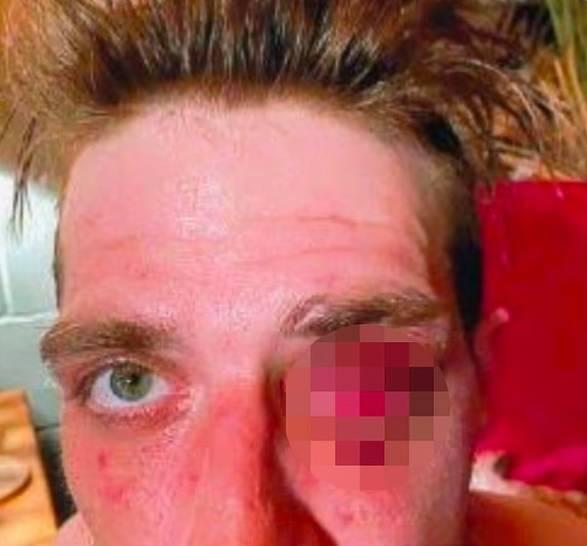 4 ملايين دولار لرجل فقد بصره بلكمة شرطي