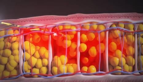 الذكاء الاصطناعي يتنبأ بفقدان الدم في جراحات شفط الدهون