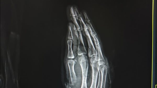 في جراحة 6 ساعات.. إنقاذ شاب تعرض لبتر كامل بإصبع الإبهام نتيجه ساطور بمستشفى سوهاج الجامعي