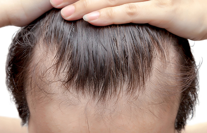 نتائج مبشرة لعلاج جديد لتساقط الشعر الوراثي.. ماذا كشفت الدراسات؟