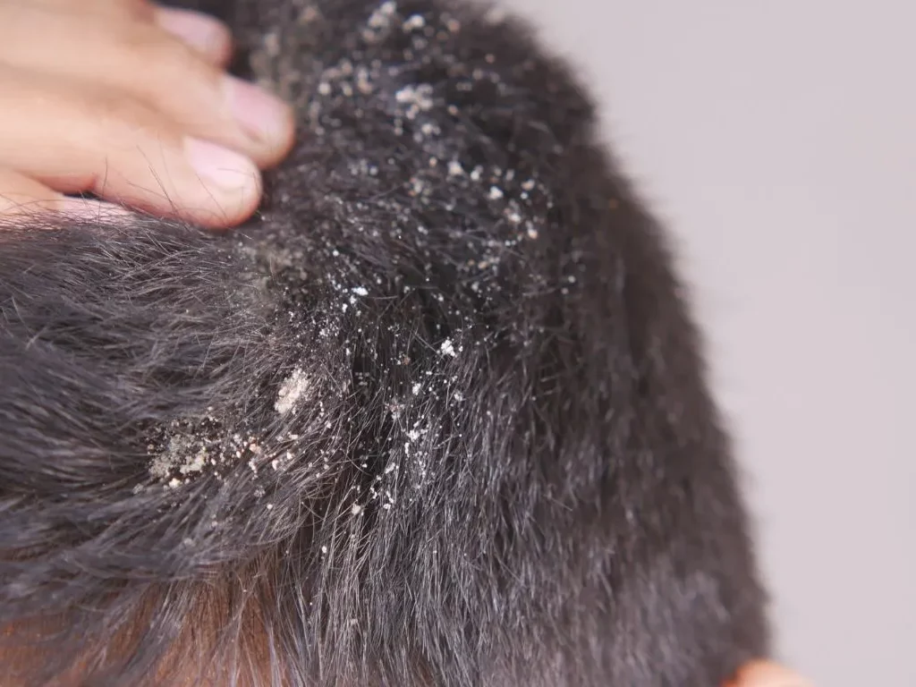 أكزيما فروة الرأس: الأعراض والعلاج للسيطرة على الحكة والتقشر