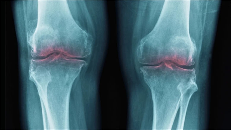 اكتشاف علمي مذهل يجدد الغضروف ويعالج آلام المفاصل