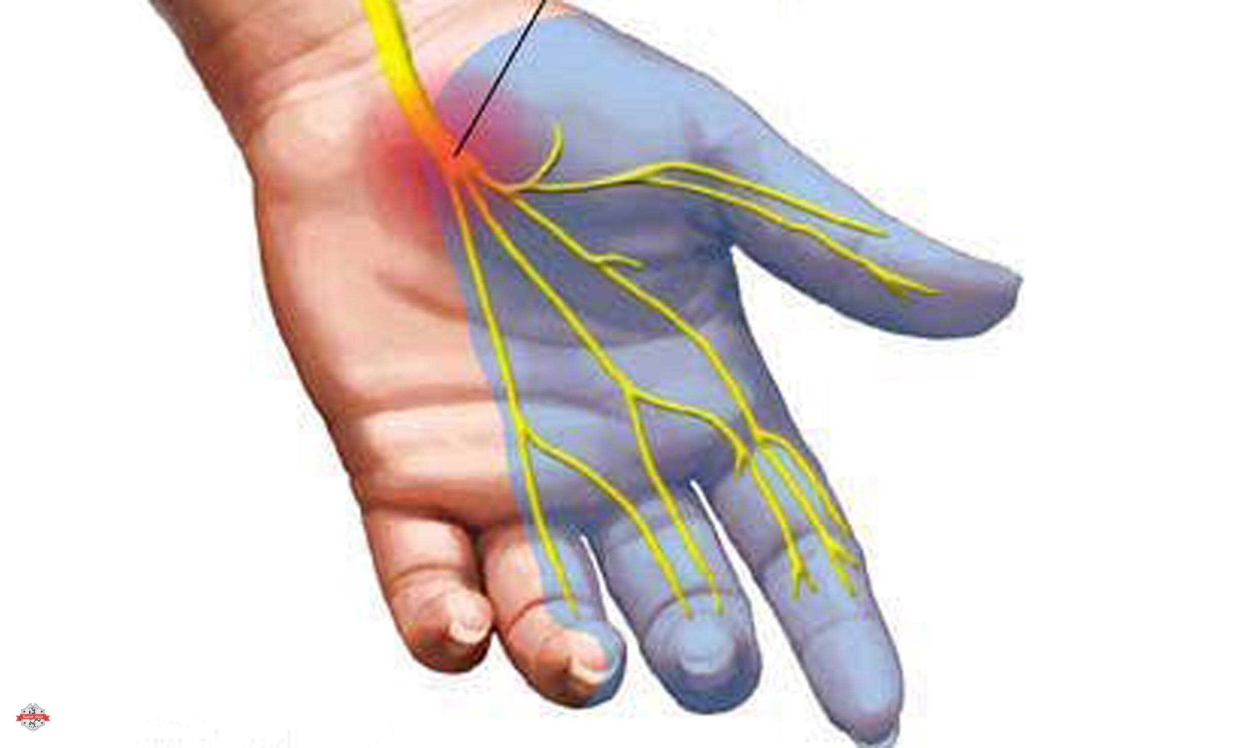 تنميل اليدين ليلاً: أسباب مقلقة ونصائح الأطباء لحماية أعصابك