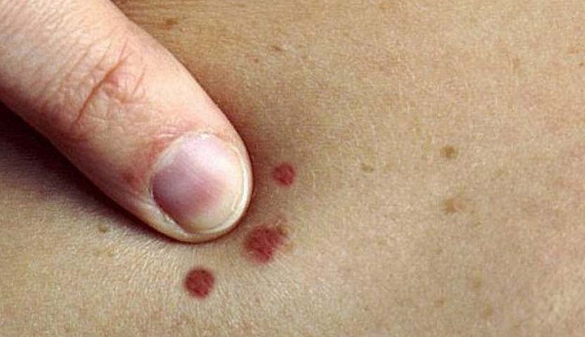 علماء يبتكرون لاصقة علاجية جديدة تقضي على سرطان الجلد الميلانيني