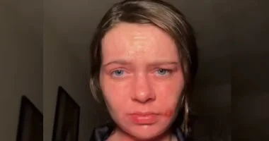 مرض مناعي نادر يحرق بشرة فتاة بريطانية بـ15 ثانية شمس