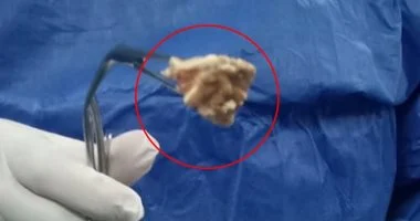صحة الدقهلية تستخرج جسماً غريباً من مريء طفلة بمستشفى المنصورة الدولي