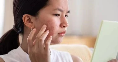 وصفات طبيعية سهلة المفعول تقضي على حب الشباب ونتائجها مدهشة